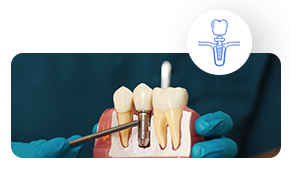 Dental-Implants https://globaldental.pk/wp-content/uploads/2025/09/Dental-Implants.png
